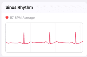 Graph of sinus rhythm