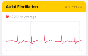 Graph of atrial fibrillation